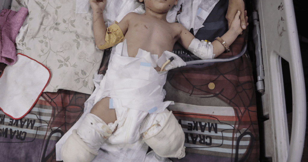 Gaza’s vulnerable suffer war’s toll: Malnourished, maimed and displaced