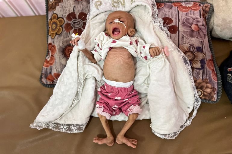 Zainab Abu Haleeb, a five-month-old Palestinian girl diagnosed with malnutrition, according to medics, lies on a bed as she receives treatment at Nasser hospital in Khan Younis, in the southern Gaza Strip July 15, 2025.
