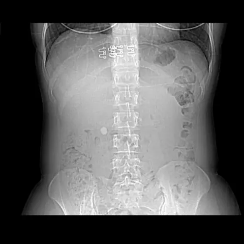 Ginger Smith Ginger Smith's x-ray showing a massive kidney stone