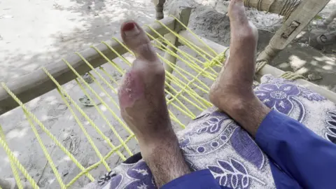 Wearing blue trousers, one of the 12 migrants who spoke to BBC Afghan Forensic lies on a bed, with a blue-and-white patterned blanket, to reveal several of his toes have been amputated.