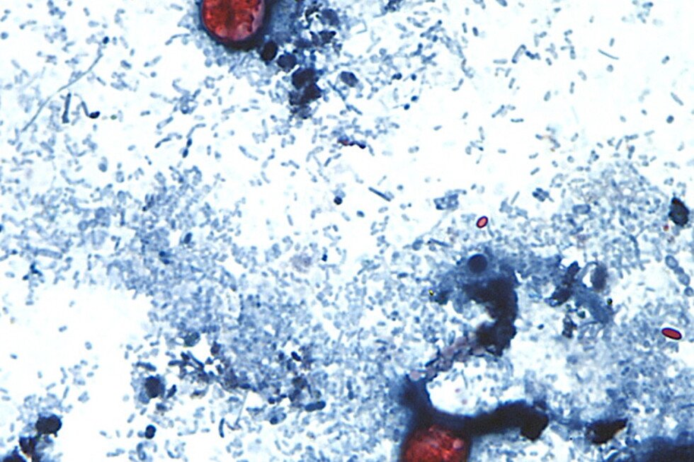 As cyclospora illnesses surge to a record, Michigan officials eye lettuce as a possible cause As cyclospora illnesses surge to a record, Michigan officials eye lettuce as a possible cause