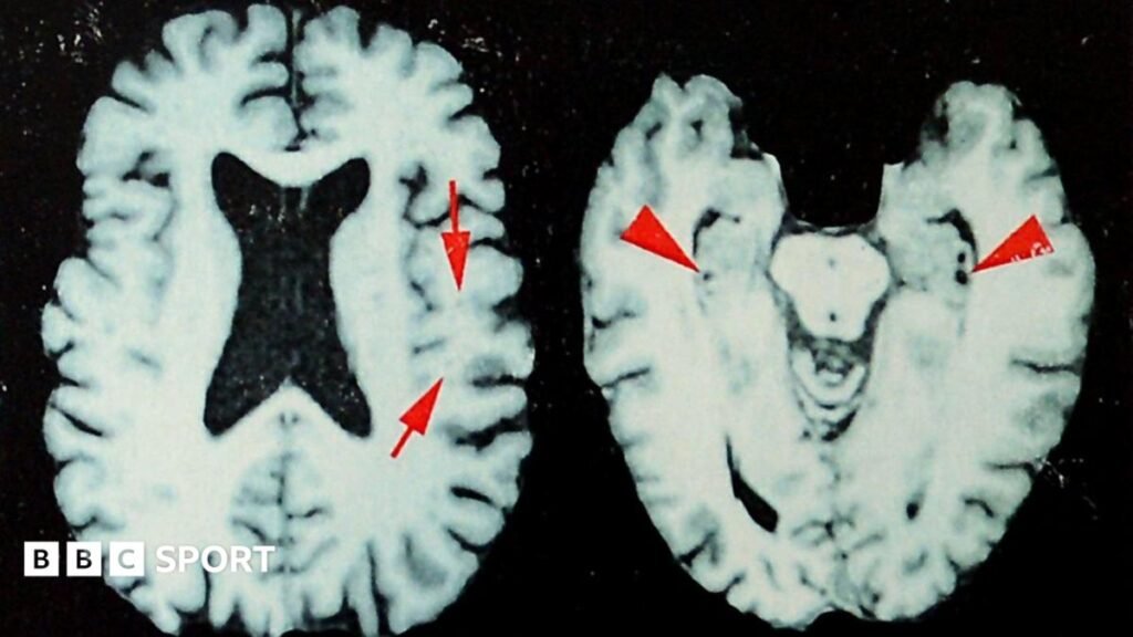 Brain disease in dead NFL players 'higher than previously shown'A new study says at least one in four ex-NFL players who died between 2016 and 2021 had a degenerative brain disease but the true figure could be much higher.8 hrs agoAmerican Football Brain disease in dead NFL players 'higher than previously shown'A new study says at least one in four ex-NFL players who died between 2016 and 2021 had a degenerative brain disease but the true figure could be much higher.8 hrs agoAmerican Football
