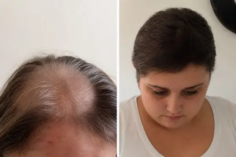 Becky Jones Two images of Becky Jones. In the left hand side you can see the effects of taking cancer drugs where her hair has thinned and greyed. In the right hand side she is looking down 